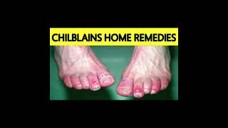 Chilblains What is chilblains Causes symptoms and home remedies for chilblains [upl. by Ecirtaeb]