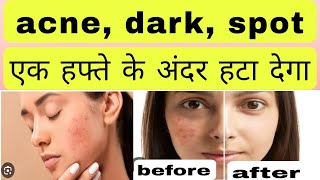 Cosmelite creamacne dark spot एक हफ्ते में हटा देगा uses in Hindi [upl. by Notnerb]