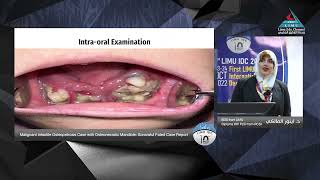 Malignant Infantile Osteopetrosis Case with Osteonecrotic Mandible Sorrowful Fated Case Report Dr [upl. by Ahkos]