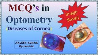 MCQS IN OPTOMETRY  Diseases of Cornea  Part 21 [upl. by Cherianne]