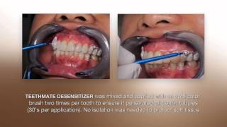 Desensitizing Procedure using the NEW TEETHMATE DESENSITIZER from Kuraray [upl. by Iviv]