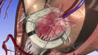 Mitral Heart Valve Ring  Medical amp Scientific Video Production [upl. by Yesrej]