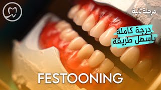 Festooning  خطوة بخطوة  طب الاسنان مرحلة ثانية [upl. by Constantina]