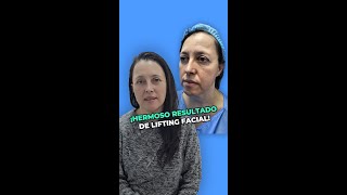 Rejuvenecimiento Facial Antes y Después ¡Increíbles Resultados [upl. by Kamin]