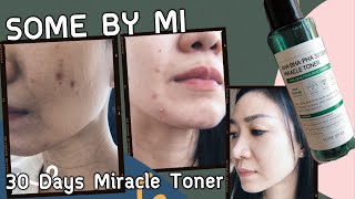 SOME BY MI 30 Days Miracle Toner รีวิวหลังใช้มาแล้ว 30วัน [upl. by Carlie]