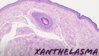 Xanthelasma xanthoma of eyelid yellow bumps around eye pathology dermpath dermatology [upl. by Viva]