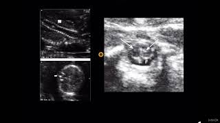 tkr03 DIASTEMATOMYELIA ULTRASOUND🚦 [upl. by Myriam]