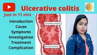 Ulcerative Colitis Versus Crohns Disease in Hindi Language [upl. by Corri702]