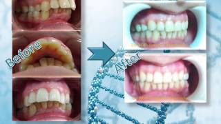 العلاج التقويمي للبروز الشديد في الأسنان العلوية Orthodontic treatment of severe protrusion [upl. by Adnic]