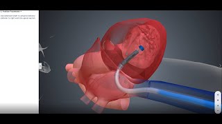 EMPOWER™ Leadless Pacemaker Implant Animation – Placement with Immediate Recapture [upl. by Flynn]