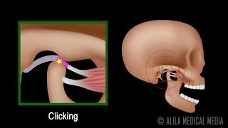 Temporomandibular Joint TMJ Anatomy and Disc Displacement Animation [upl. by Mackay893]