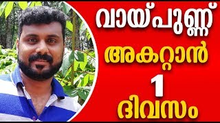 വായ്പ്പുണ്ണ് ഒരു ദിവസം കൊണ്ട് മാറ്റാന്‍ Mouth Ulcer Home Remedy [upl. by Gievlos]