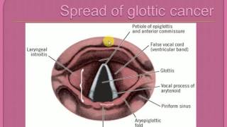 CANCER LARYNX part1  TNM classification  sites of occurance  selflessmedicose [upl. by Lukash]