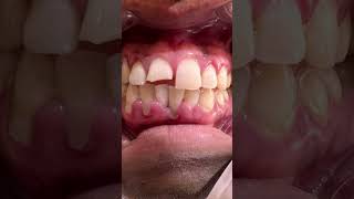 Dental talk 29Root caries rootcaries rootcanalspecialist rootcanals oralcare [upl. by Fital]