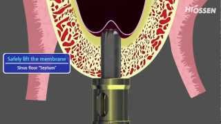 OSSTEM  HIOSSEN CASKit Crestal Approach Sinus Kit [upl. by Garate]