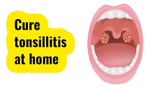 Effective tonsillitis home remedies  easy to use [upl. by Gayle]