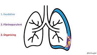 Empyema and Pleural Effusions [upl. by Malynda]