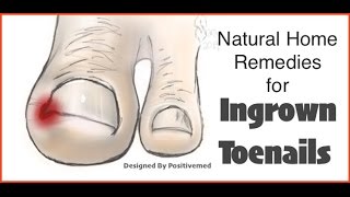 Natural Home Remedies for Ingrown Toenails [upl. by Sutherland472]