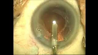 The Fladen Eye Center Capsular Tension Ring [upl. by Ecnahs454]