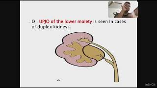 Surgery ureter disorder part 2 [upl. by Yelrak]