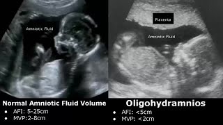 Obstetric Ultrasound Normal Vs Abnormal Images  Fetal Placenta Umbilical Cord Pathologies USG [upl. by Reamonn284]