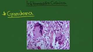 Inflamação Crônica  Resumo  Patologia Geral [upl. by Deloria]