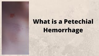 What is a Petechial Hemorrhage [upl. by Kursh]