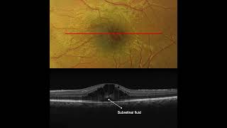 Cystoid Macular Edema in Pars Planitis OCT Interpretation [upl. by Scharf]