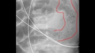 Enterocolite necrotizante com pneumatose intestinal [upl. by Cacia]