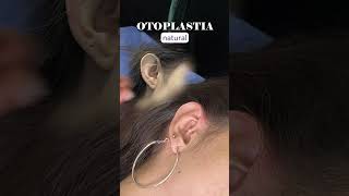 POSTOPERATORIO OTOPLASTIA cirugiasplasticas [upl. by Litman]