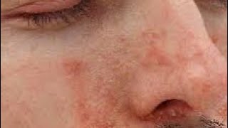 Treating Facial Psoriasis [upl. by Ailongam]