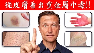 【皮膚】重金屬中毒症狀排出毒素自然療法柏格醫生 Dr Berg [upl. by Edyaj891]