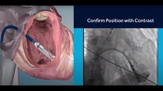 Weekly Checkup  Leadless Pacemaker [upl. by Hannazus748]