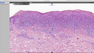 Lichenoid keratosis Phillip H McKee Antonina Kalmykova amp CSD Health Care [upl. by Dorri]