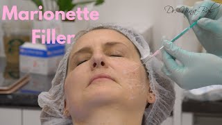 Filler Marionette Lines Before and After 💕 Dr Nina Bal 💕 Facial Sculpting [upl. by Noyerb]