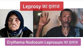 Leprosy का इलाज  Treatment of Leprosy  कुष्ट रोग  Erythema Nodosum Leprosum का इलाज़ Leprosy [upl. by Yremrej237]