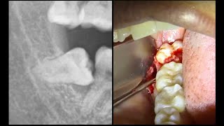 Extracción MUELA DEL JUICIO horizontal  Extracción de cordal incluido [upl. by Dazraf]