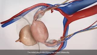 Laparoscopic bilateral salpingooophorectomy BSO [upl. by Tnerb]