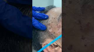 Say goodbye to the unwanted moles skin tags or any lesions  Dr MediSpa [upl. by Nahtan]