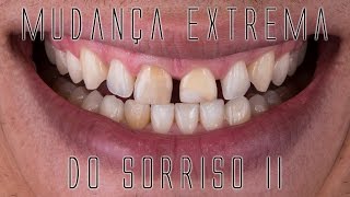 Mudança extrema do sorriso II Os bastidores das facetas e lentes de contato dentais [upl. by Lorri27]