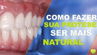 Como Fazer a Prótese com Implantes parecer Natural [upl. by Earahs113]