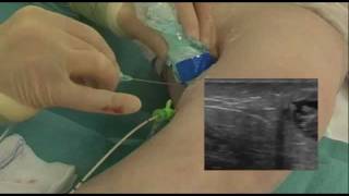 Patient Video of Radiofrequency ablation of Varicose Veins with the RFiTT system [upl. by Rora79]