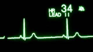 Sinus Bradycardia [upl. by Manlove]