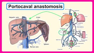 portocaval anastomosis [upl. by Brandenburg]