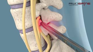 Fullendoscopic spinal treatment of herniated discs and spinal canal stenosis [upl. by Eveivenej]