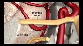 Treatment for Trigeminal Neuralgia UCSF Neurosurgery [upl. by Llehcnom]