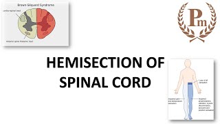 Learn the features of Hemisection of Spinal Cord as a PRO [upl. by Hernandez]