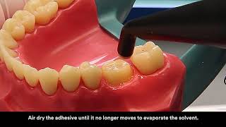 3M™ RelyX™ Ultimate Adhesive Resin Cement Application Video [upl. by Bobseine]