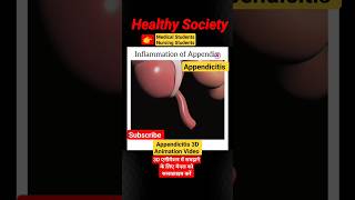 Appendicitis 3D Animation Healthy Society viralvideo Doctorhealth youtubeshortsvideo [upl. by Aruol576]