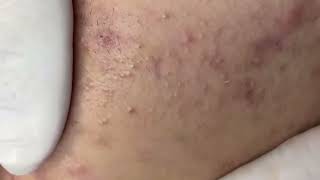 Blackheads amp Whiteheads Removal New On Cheek 2024 Acne Treatment With Nhat Bang [upl. by Drogin]